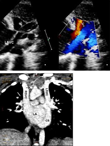 2d echo with cfds